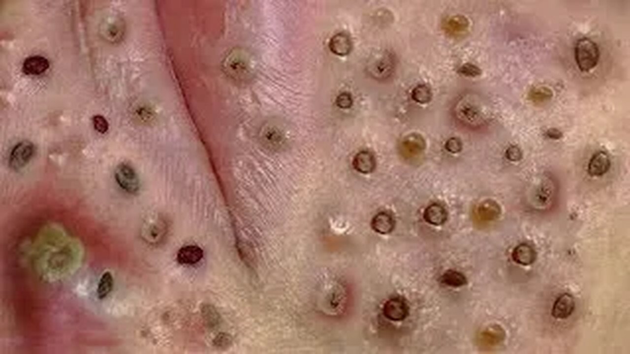 Satisfying blackhead removal, relaxing Pimple Popping 118