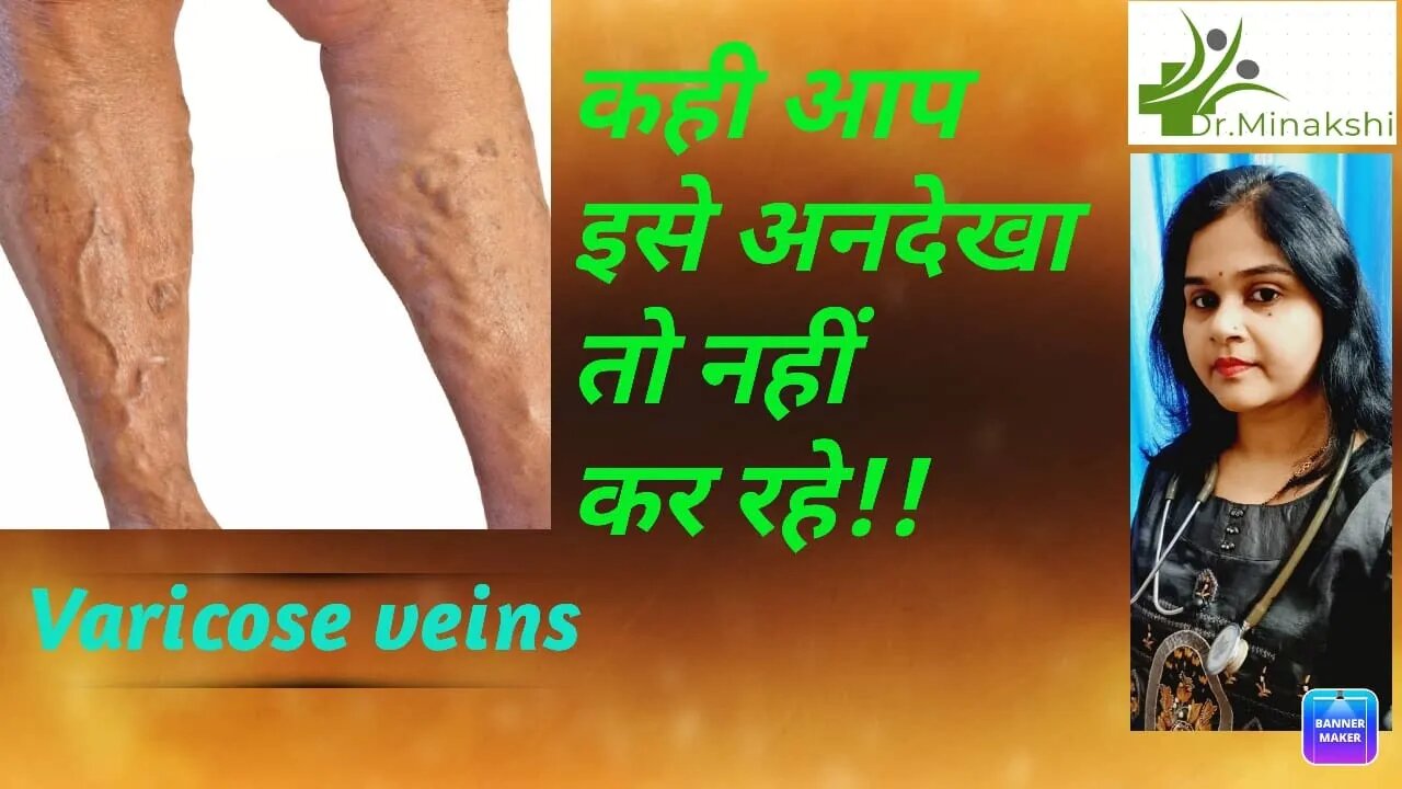 Varicose (Spider) Veins, Causes, Symptoms, and Treatments #drminakshisingh