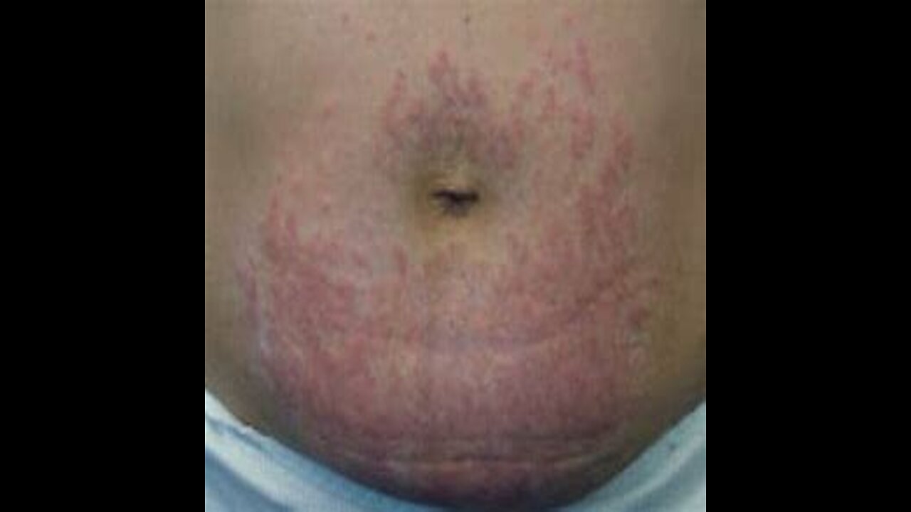 44. Skin Rash - Cholestasis