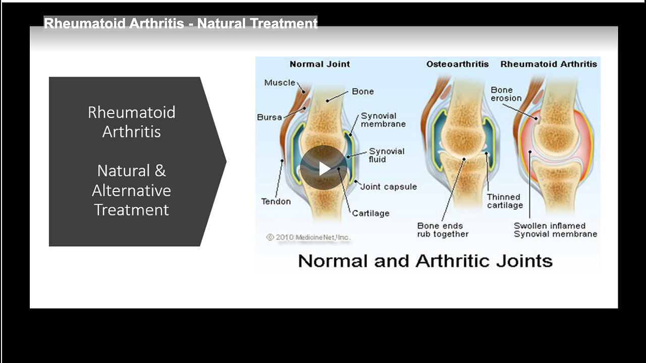 Rheumatoid Arthritis - Natural Treatment