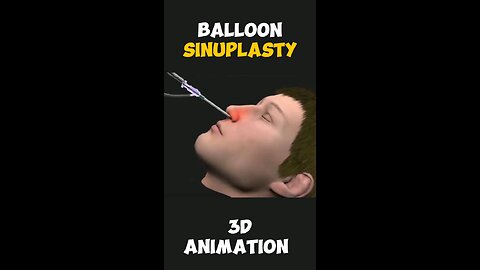 Balloon Sinuplasty