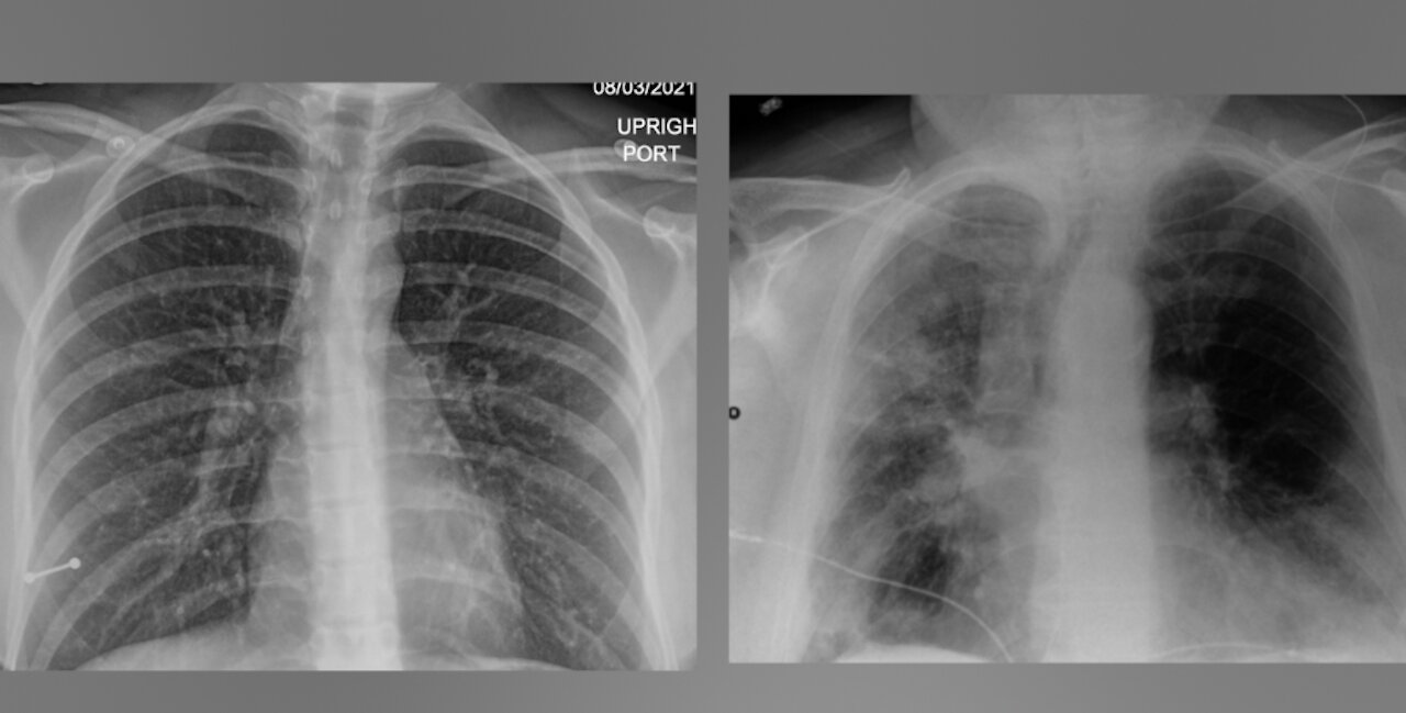 COVID lung X-rays of San Diego patients show 'remarkable' impact of vaccines