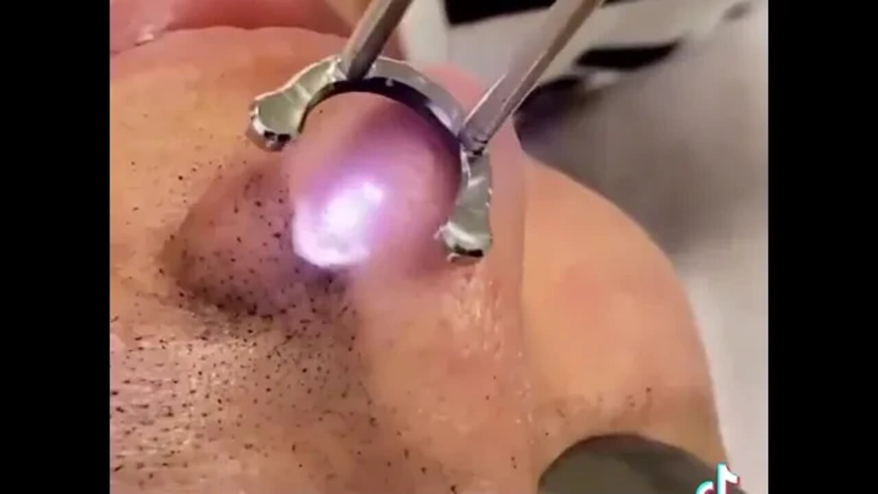 Incredible blackhead carbon laser treatment 😳 WOW #shorts #blackheadremoval #blackhead #blackheads