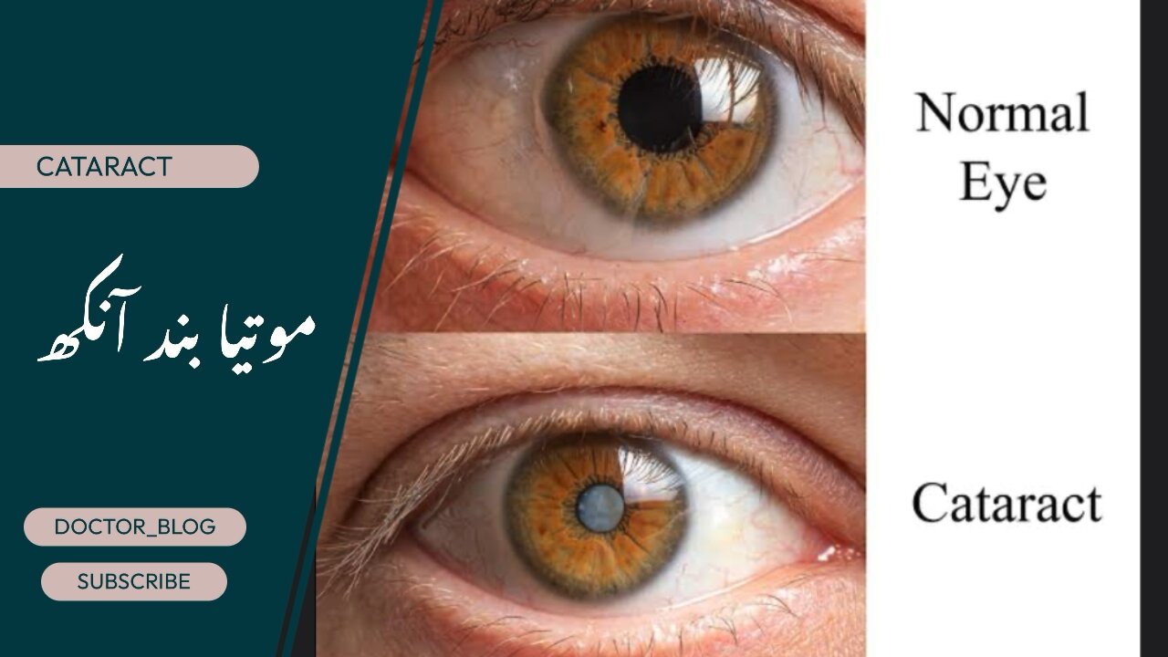 Surgery of cataract eye