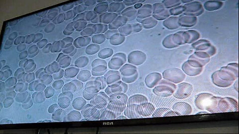 Lyme & Co-Infections Removed at 98% in 16 Months