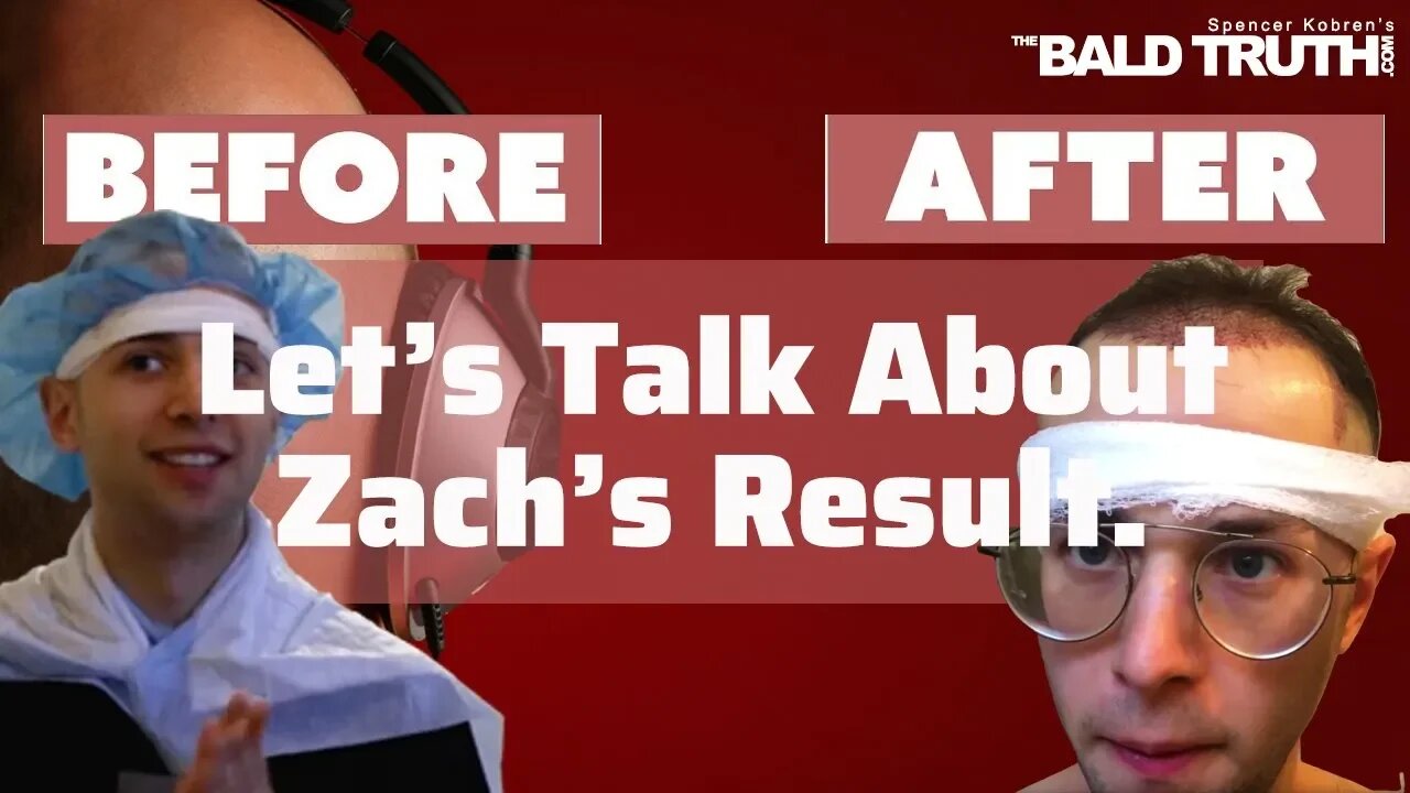 Zach's Hair Transplant Update-The Bald Truth -April 12, 2020