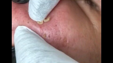 Blackheads episode 9