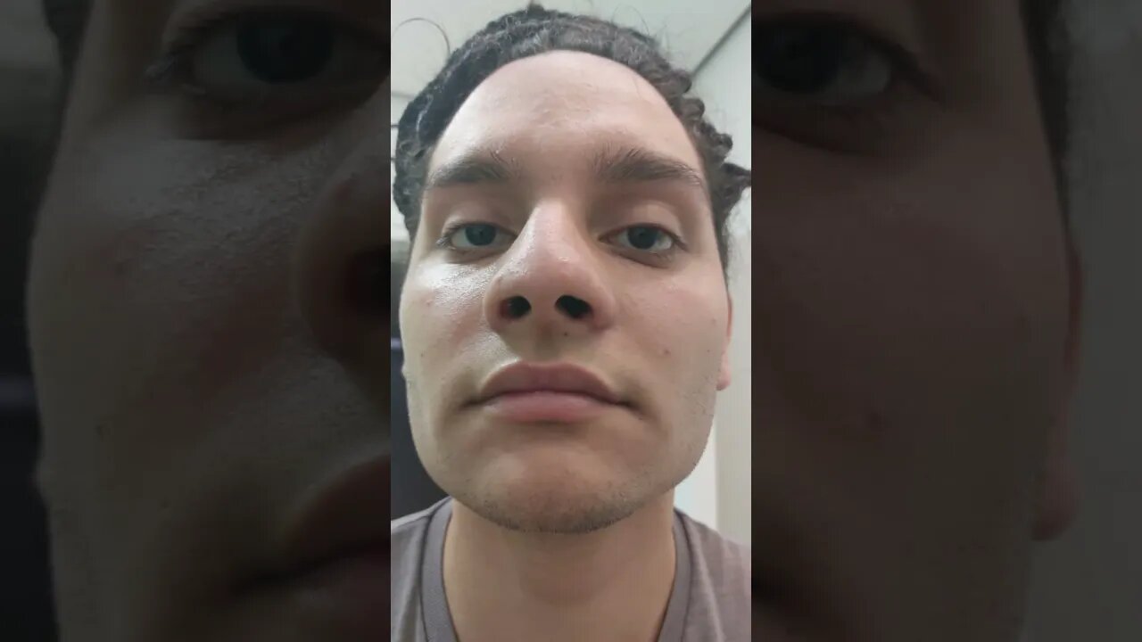 ANTES e DEPOIS de usar MINOXIDIL KIRKLAND por 6 MESES😱