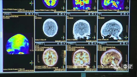 USF conducting new study to combat Alzheimer's