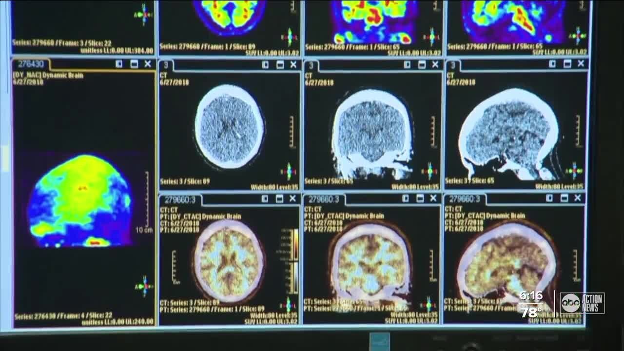 USF conducting new study to combat Alzheimer's