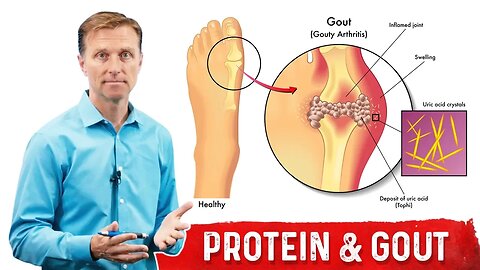 Why Does Dietary Protein NOT Cause Gout? – Dr.Berg