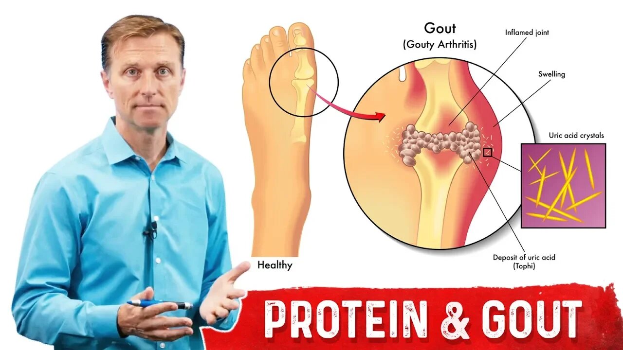 Why Does Dietary Protein NOT Cause Gout? – Dr.Berg