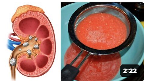 How To Cleanse & Detox Your Kidneys Naturally