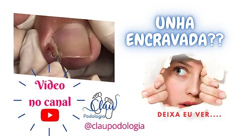 Diga adeus à unha encravada!!! #unhaencravada #podologia #nails #ingrown_toenail