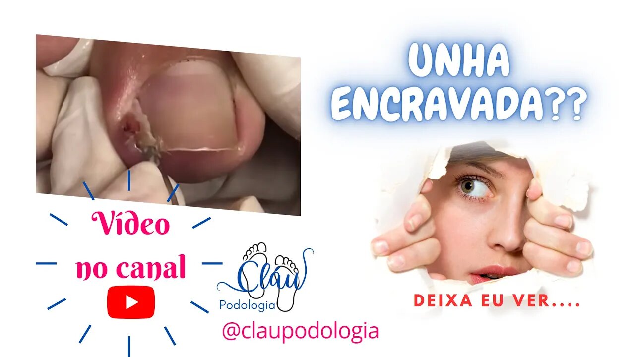 Diga adeus à unha encravada!!! #unhaencravada #podologia #nails #ingrown_toenail