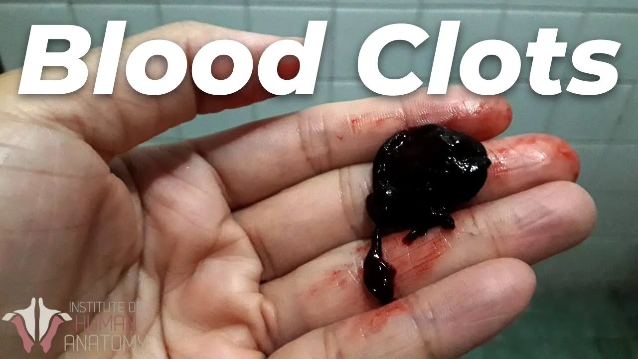 What You NEED to Know About Blood Clots...