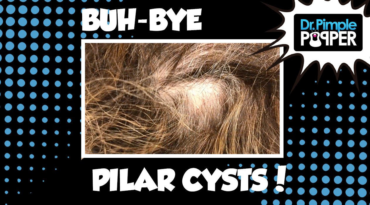 Buh-Bye Pilar Cysts!