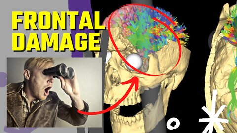 Frontal Damage - The Brain Injury That Changes Your Personality