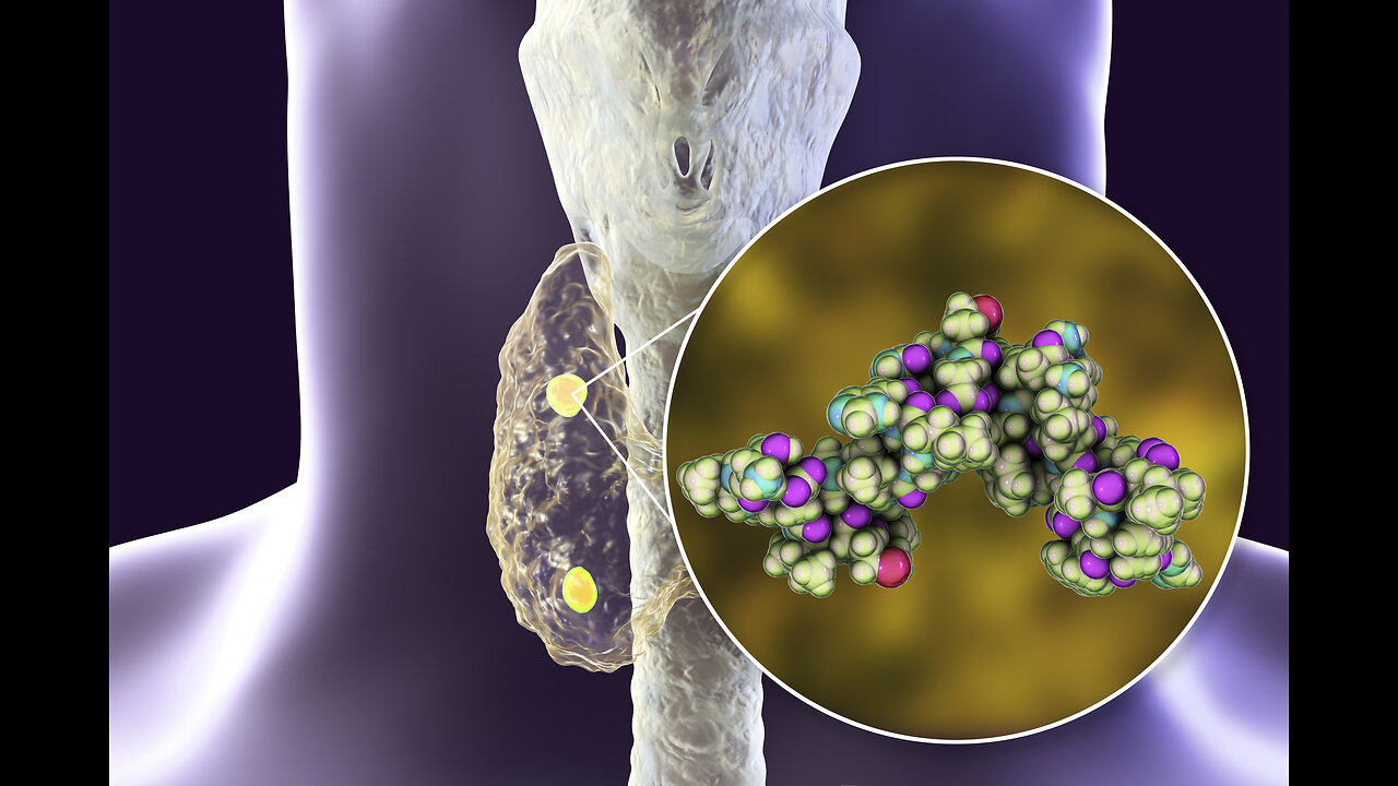 Hyperparathyroidism - Could this be YOU?