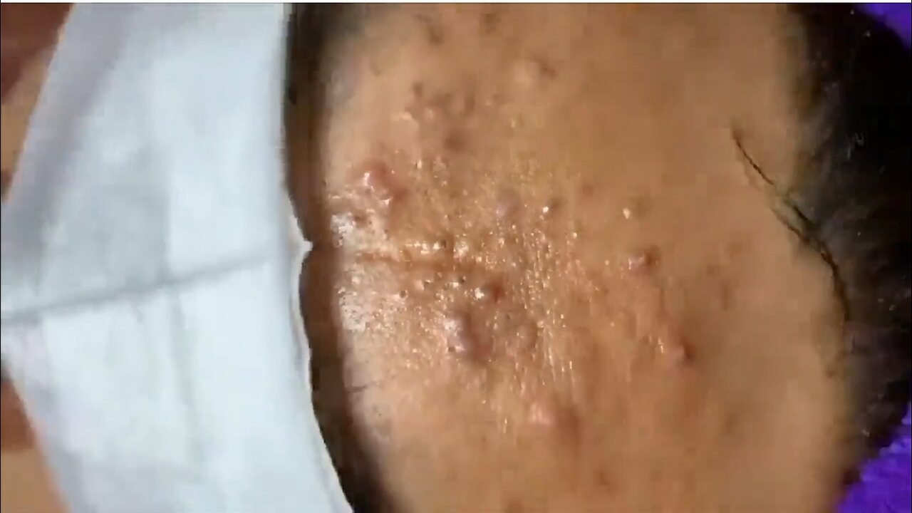 Massive Blackheads Builtup