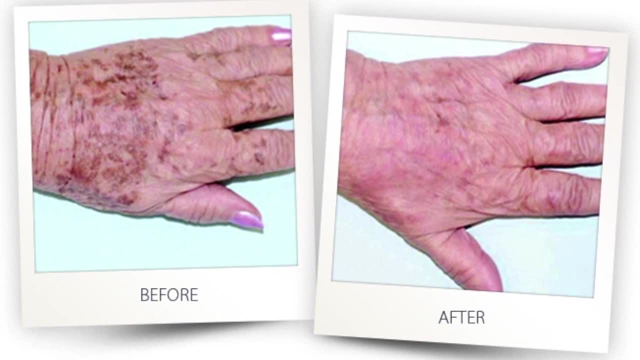 Turn Back Time Spa & Wellness Clinic can help zap dark spots away