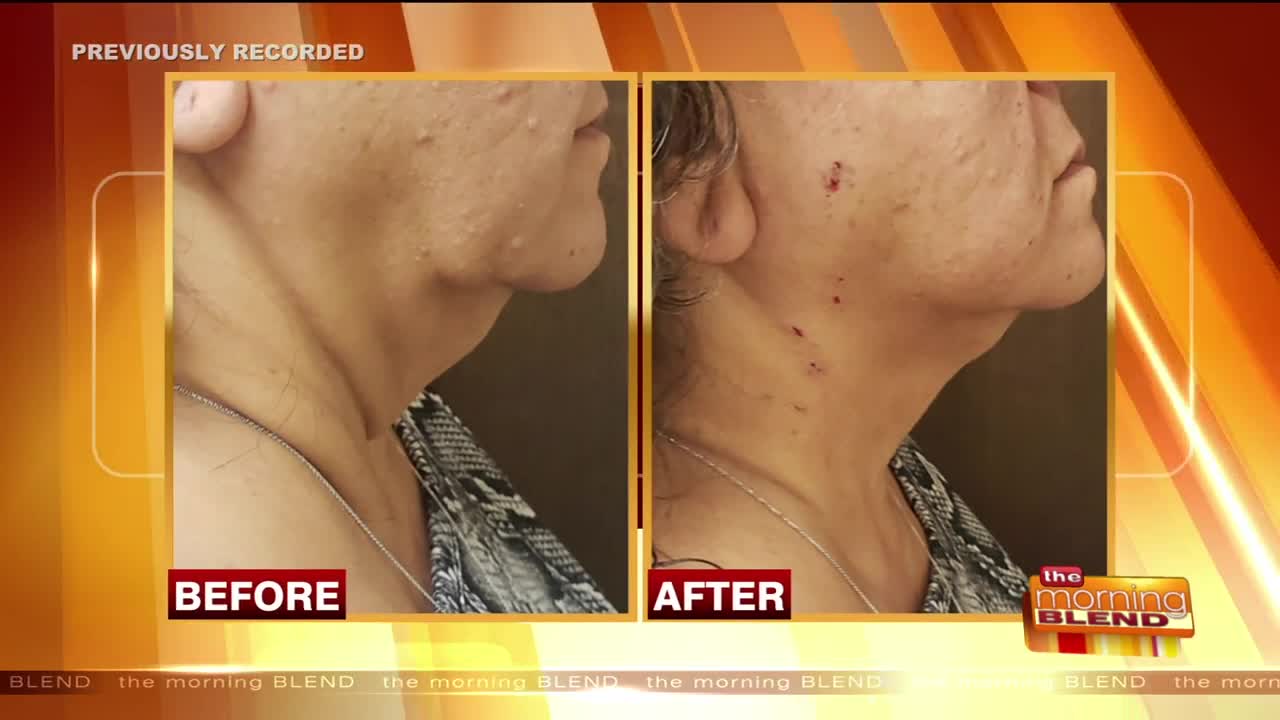 50 is the New 30 with a Non-Surgical Face Lift