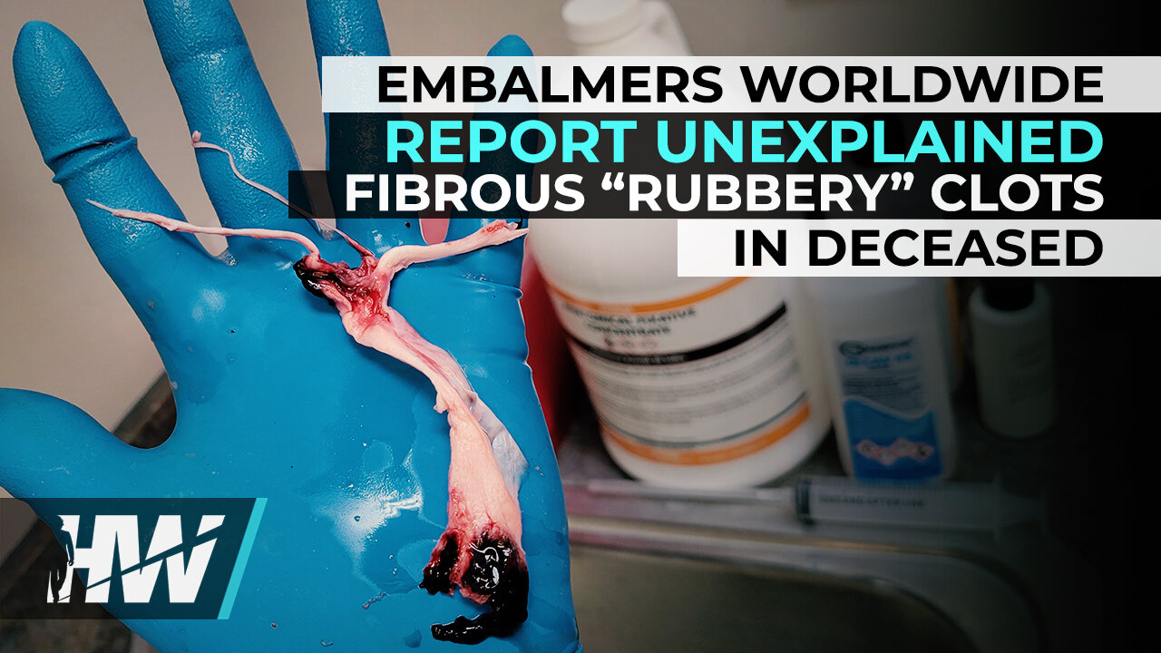 EMBALMERS WORLDWIDE REPORT UNEXPLAINED FIBROUS “RUBBERY” CLOTS IN DECEASED