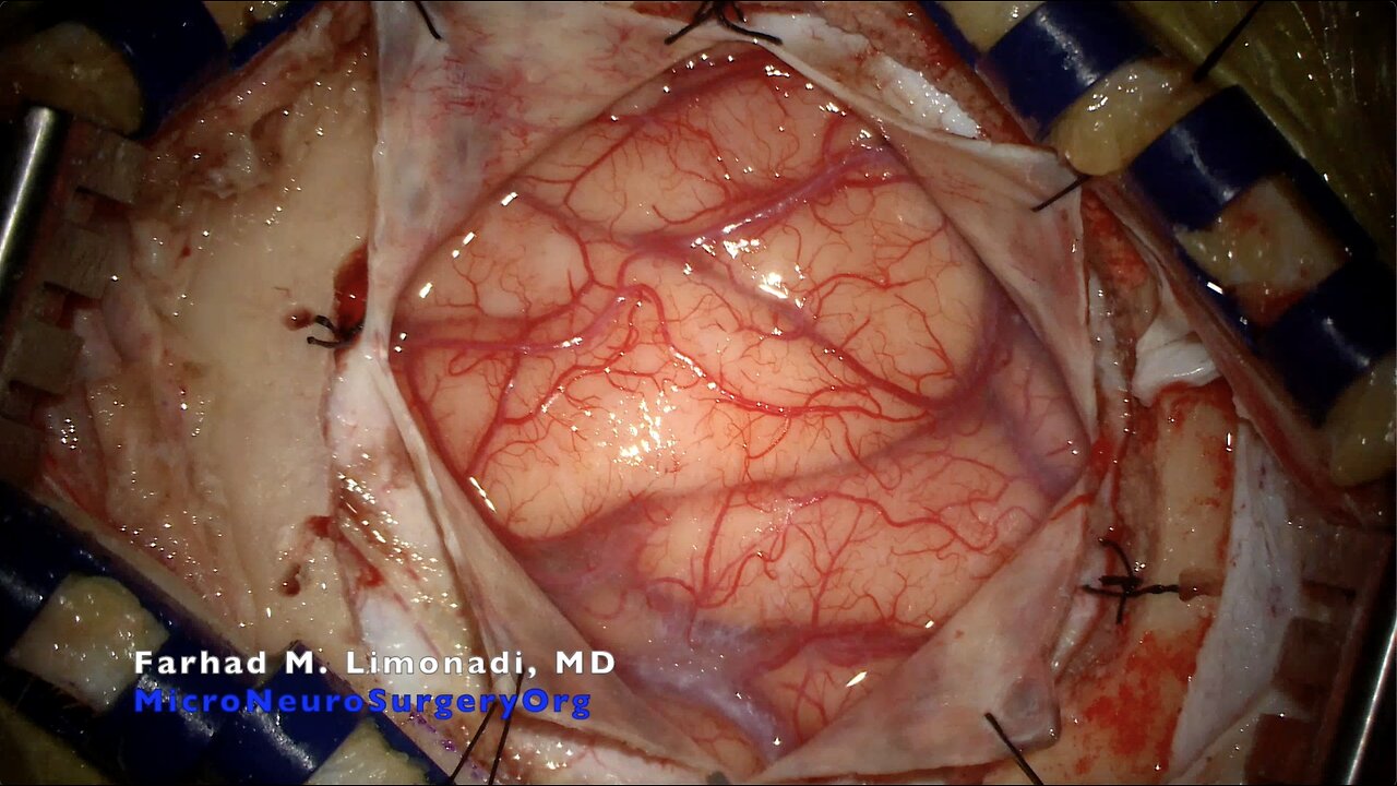 Parietal Craniotomy for Resection of Glioblastoma (GBM)