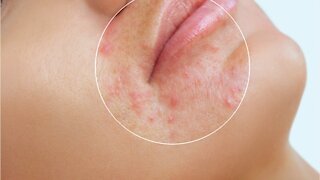 What Is Post-Inflammatory Erythema and How To Treat It
