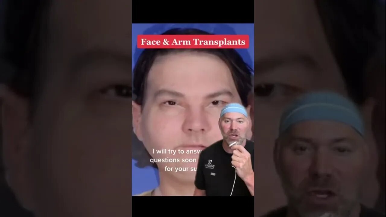 Shocking Full Face Transplant 😱 #shorts