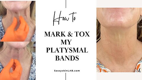 Let’s Mark Up & Tox - Platysmal Bands (Full Video)