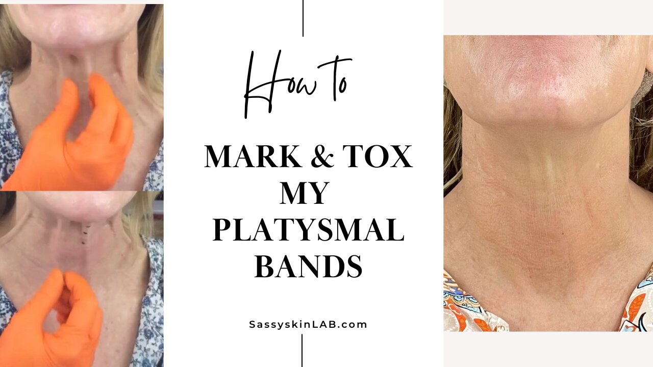 Let’s Mark Up & Tox - Platysmal Bands (Full Video)