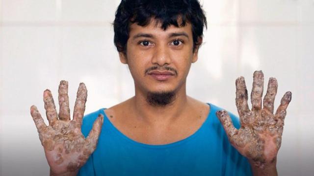 "Tree Man" Receives Surgery For Rare Illness