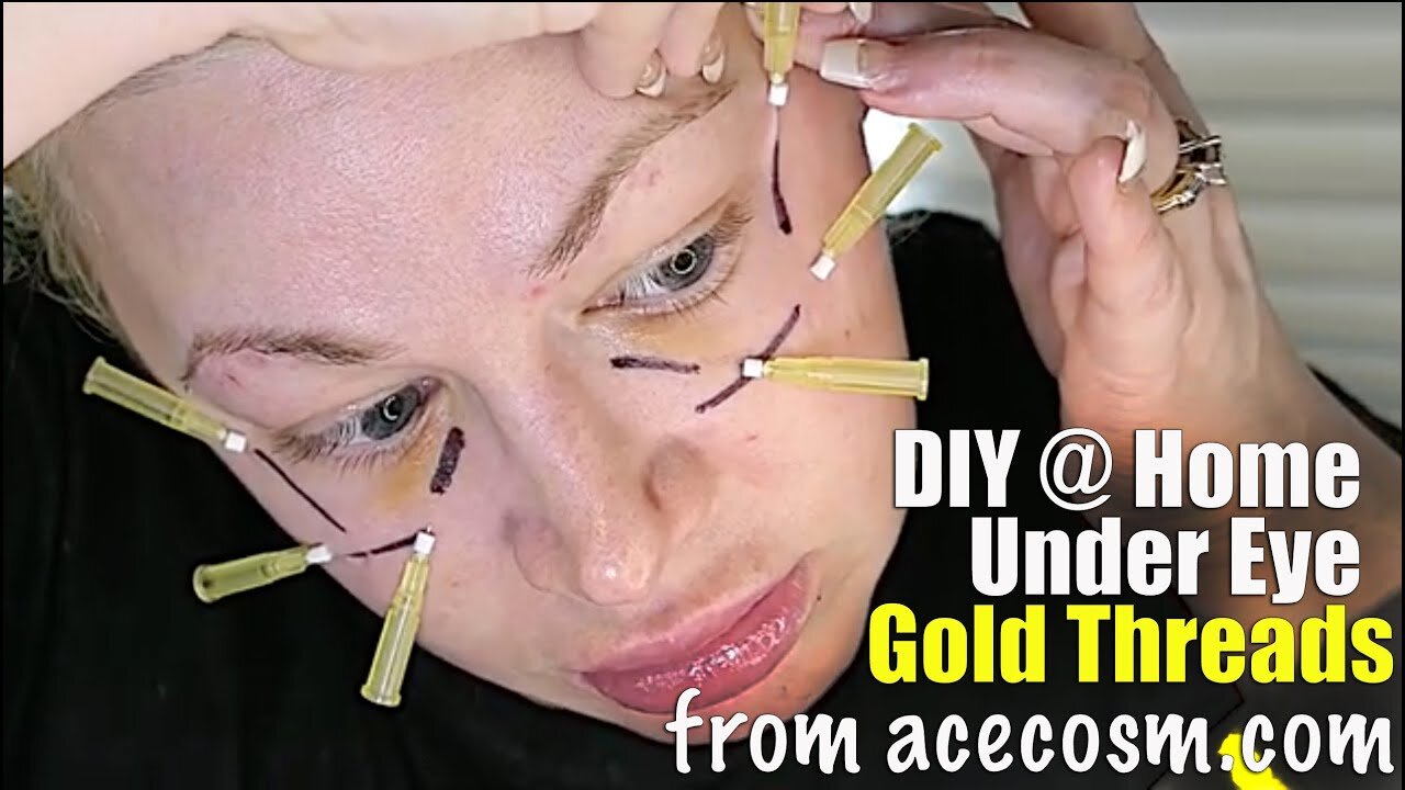 DIY Gold Threads in my Under Eye Circles from Acecosm.com | Code Jessica10 saves you $