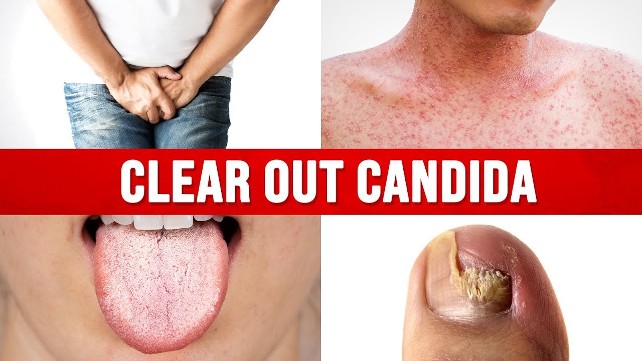 The ONLY Way to Cure Candida for Good