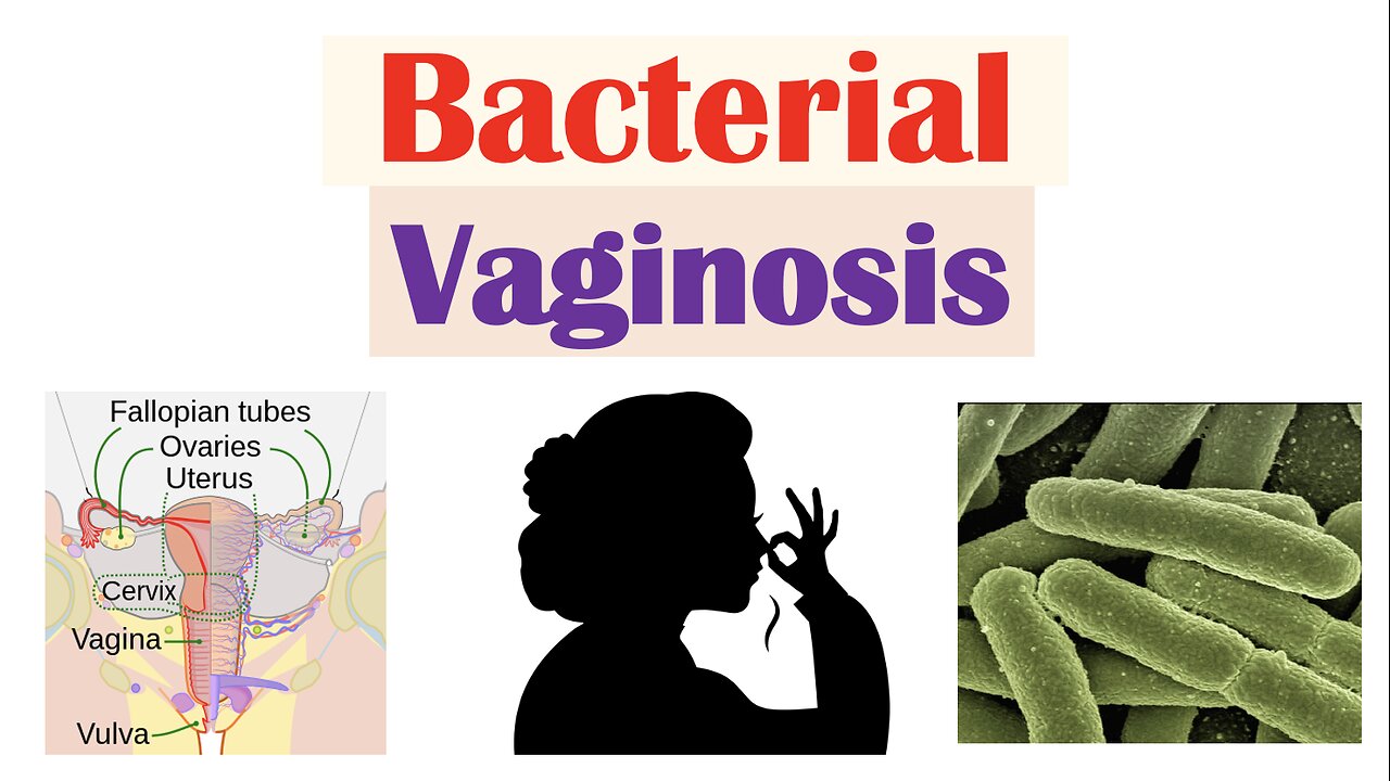 Bacterial Vaginosis (Vaginal Infection) | Causes, Risk Factors, Symptoms, Diagnosis, Treatment