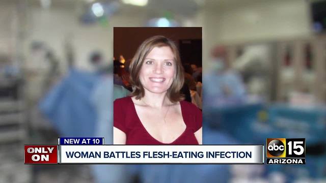 Valley woman battling flesh eating infection