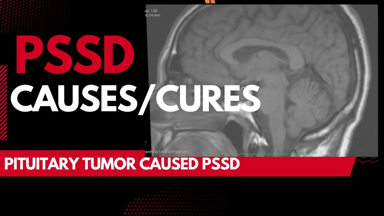 PSSD Caused by Pituitary Tumor (MRI inside + CURED + PSSD Breakdown)