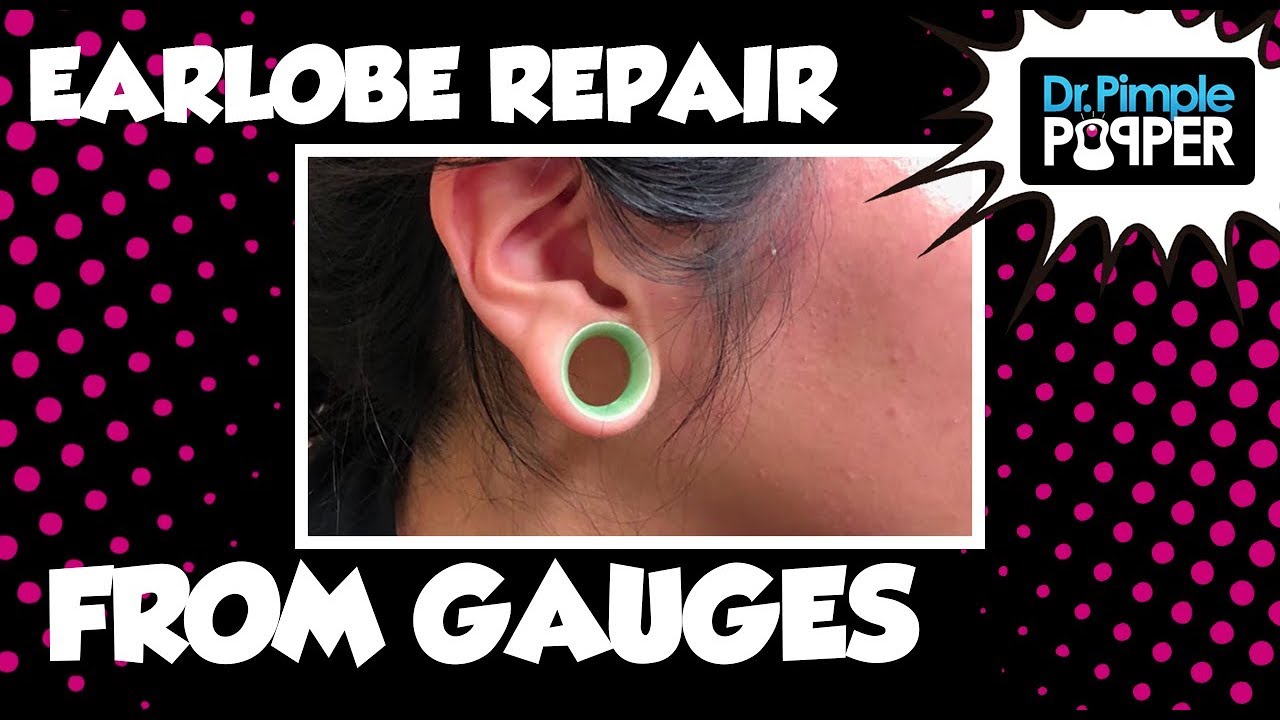 Earlobe Repair Surgery After Gauges