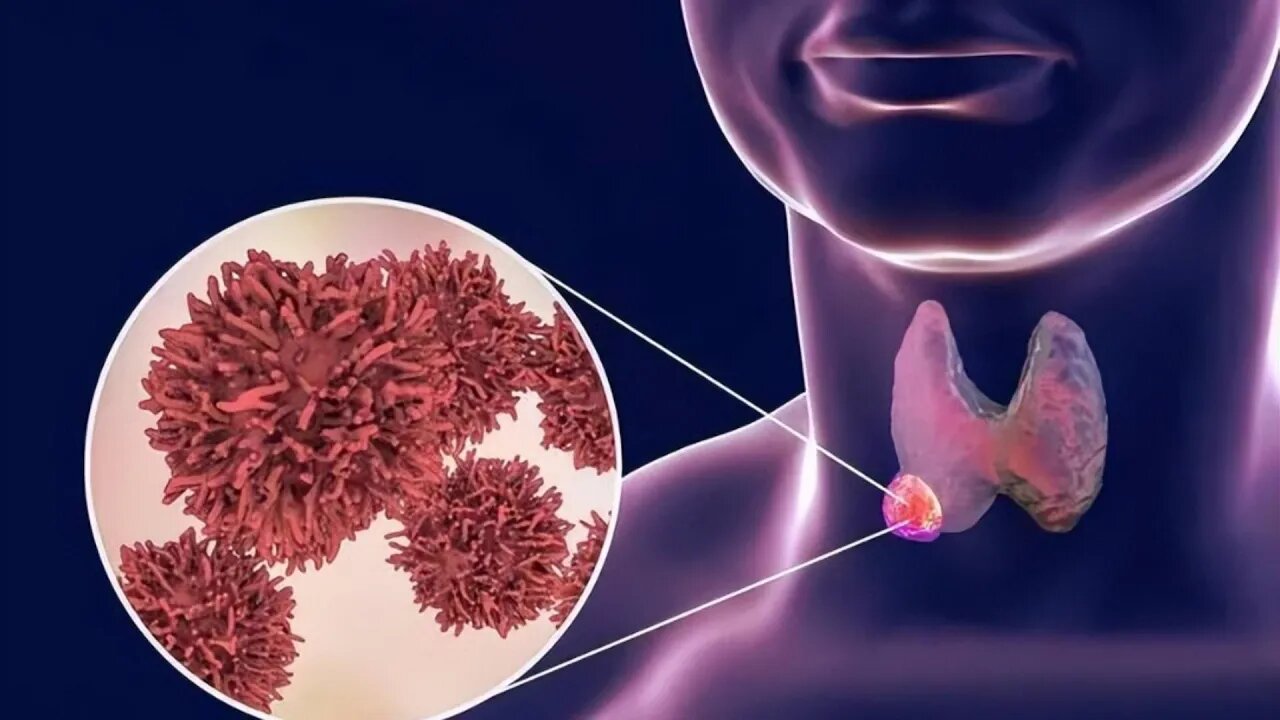 갑상선 결절의 화근을 찾았다 조언맛있는 음식 4가지