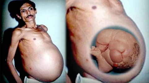 10 Things Found Growing Inside People 