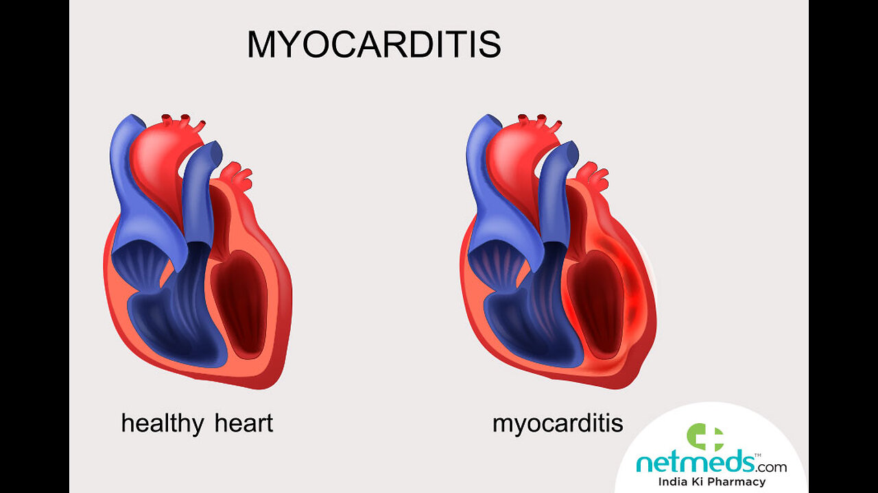 Myocarditis No longer Rare. but only 1%