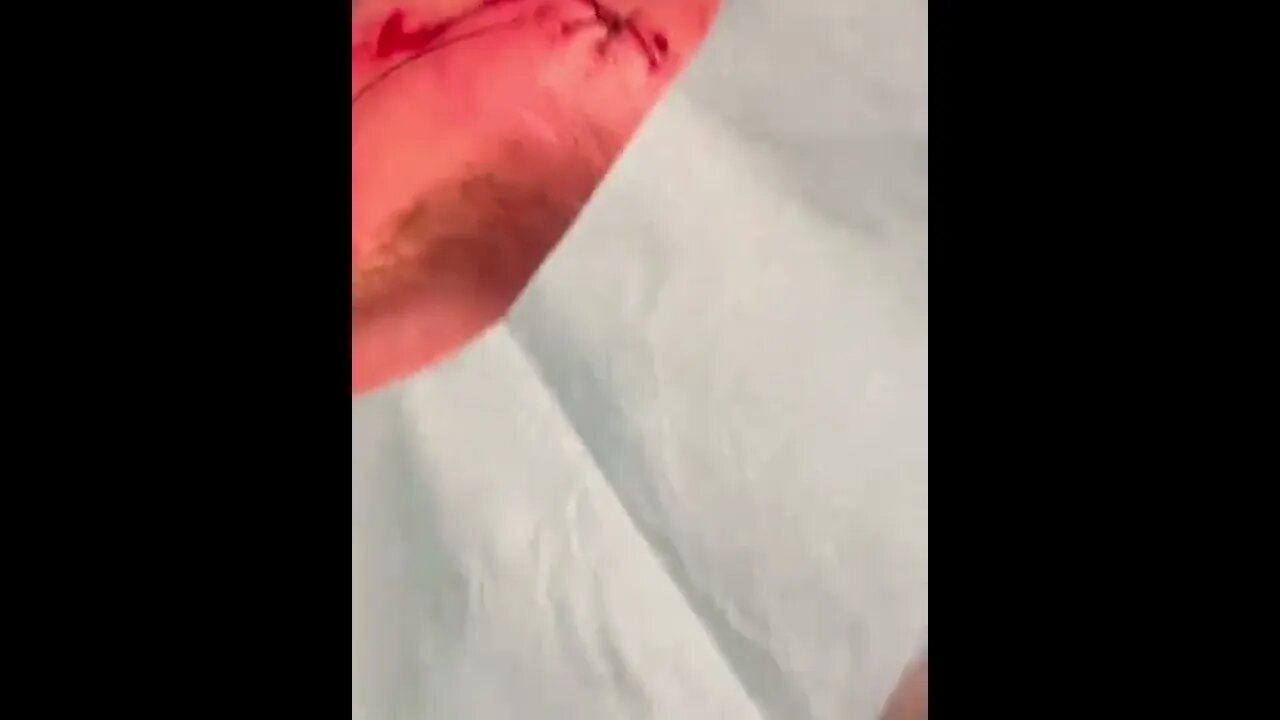 Stephen “Wonderboy” Thompson gets his face stitched up
