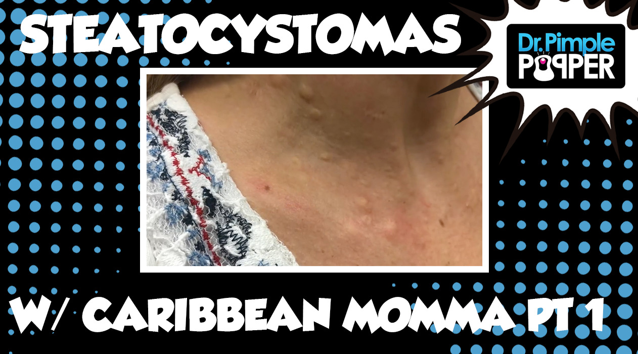 Caribbean Momma & Her Steatocystomas! Session One, Part One