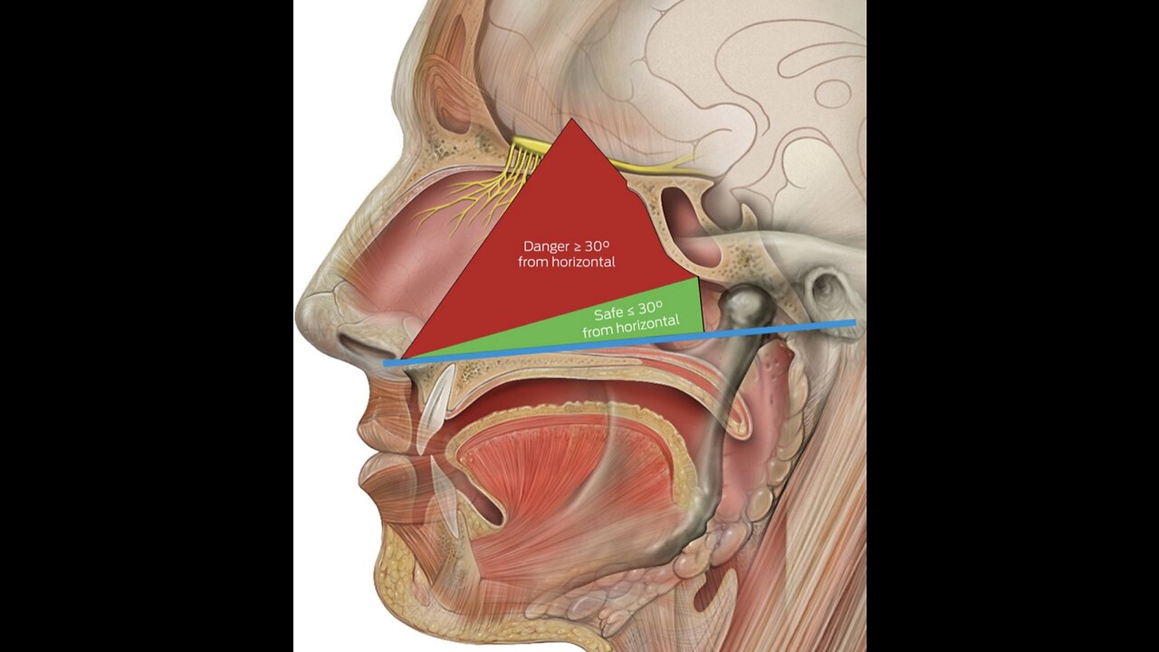 Danger: Covid nasal test swab injury.