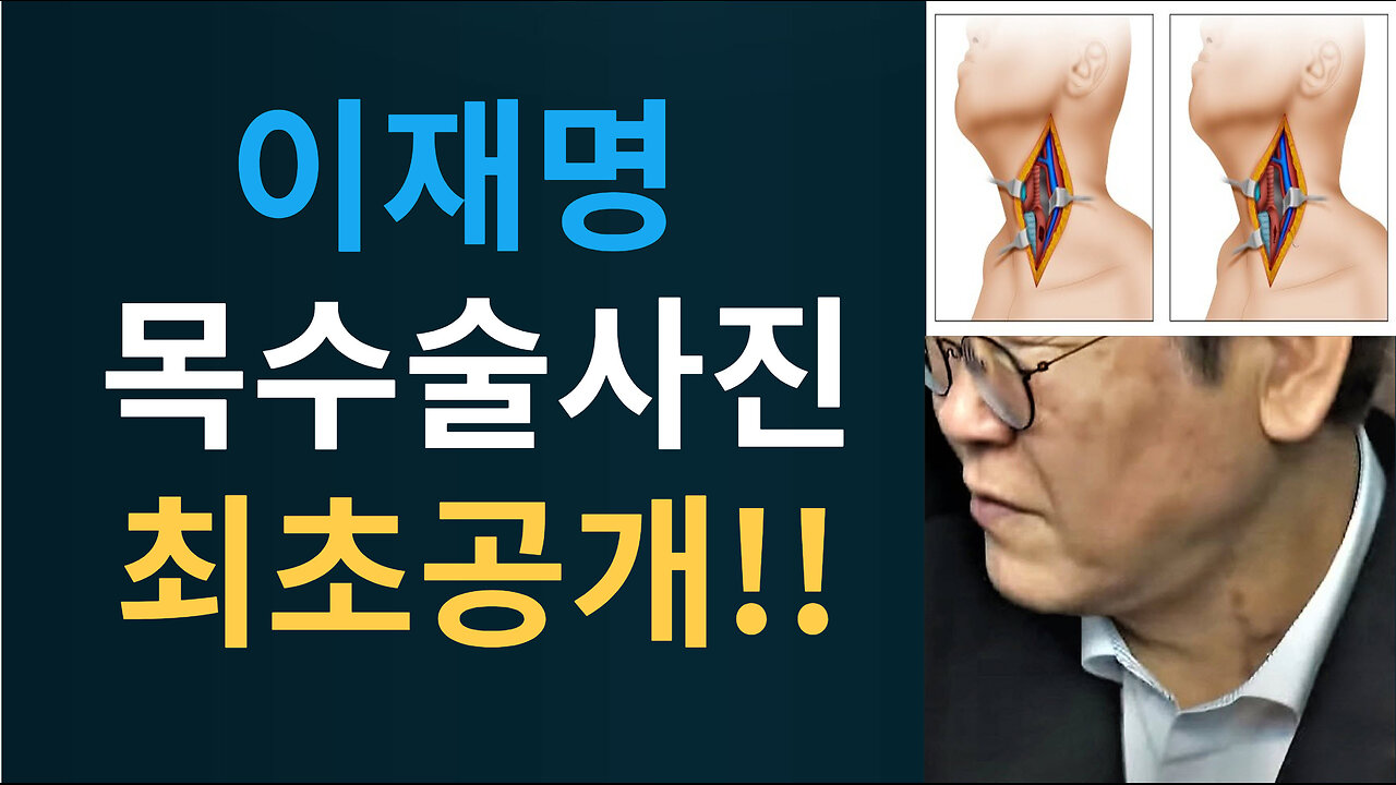 이재명 주작피습쇼,,이재명 목수술사진 최초공개!!!