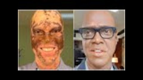 TV Reporter Paints His Skin Every Day To Save His Career