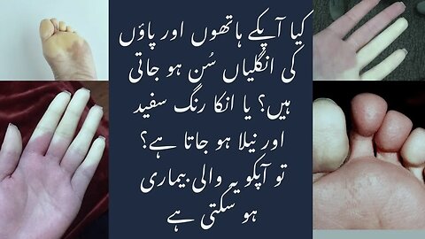 Raynaud's disease in Urdu