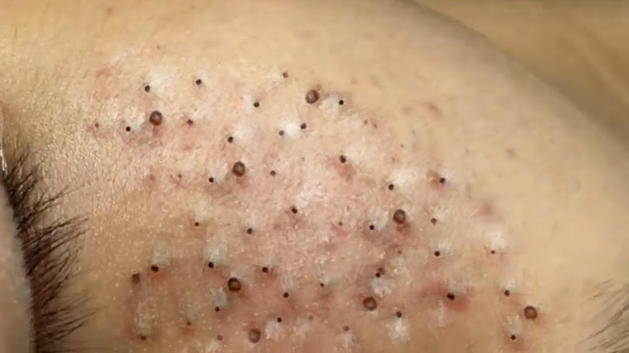 Removing Acne and Blackheads Treatment, #28