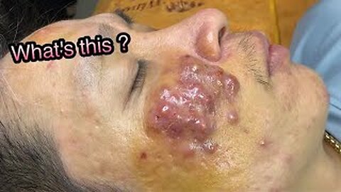 BOIL is severely inflamed Blackhead removal